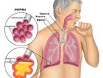 Доктор: в Курской области увеличился рост заболеваемости пневмонией
